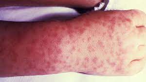 Rocly mountain fever.jpg